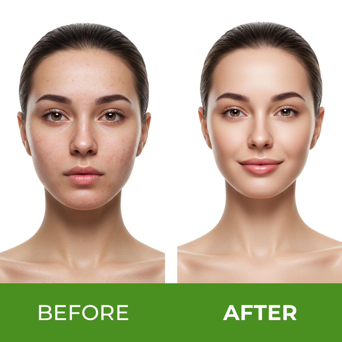 Azelaic Acid Serum