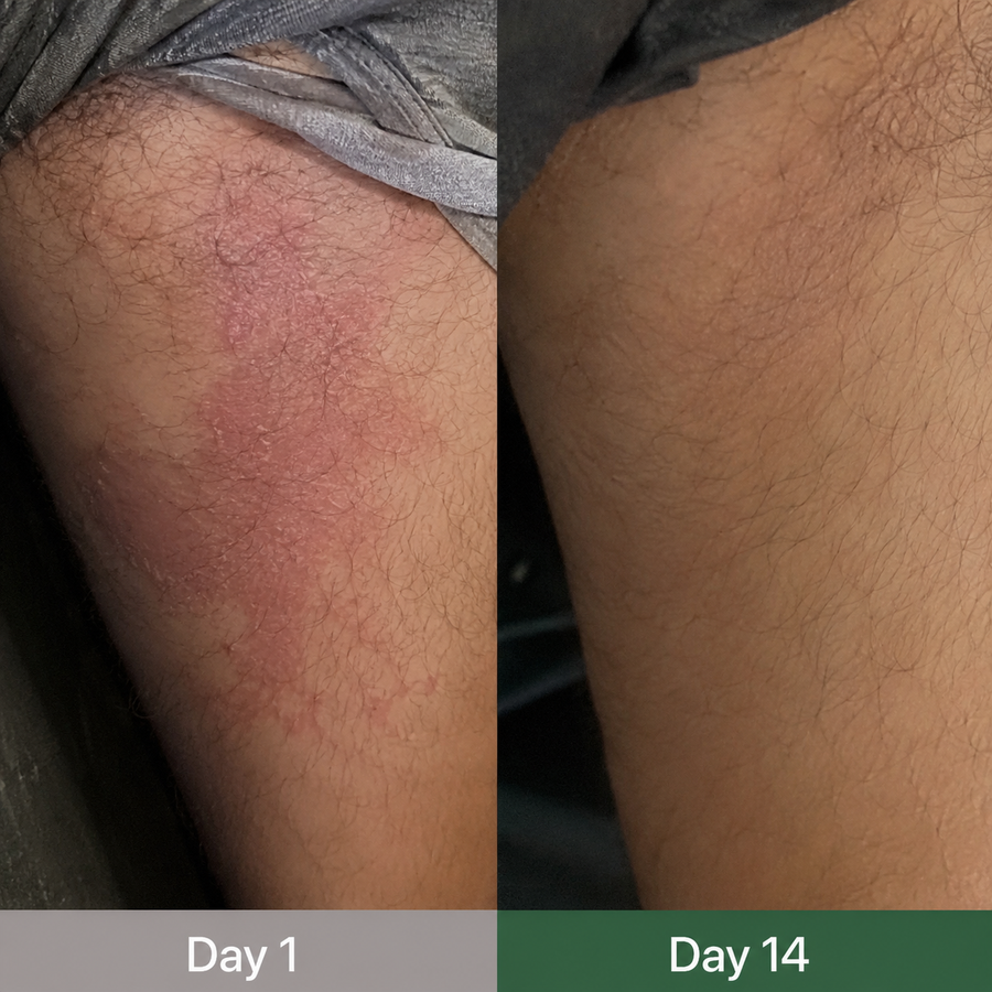 Itching didn’t come back.