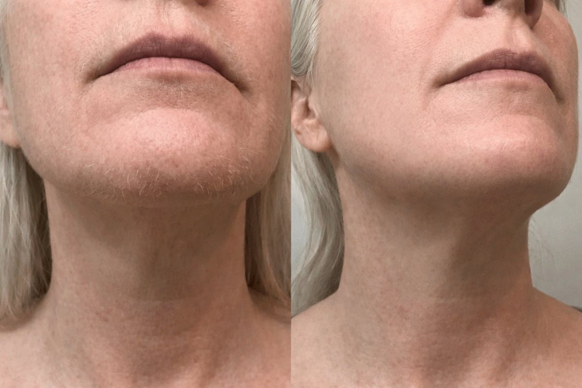 Before and after results - Maria L.
