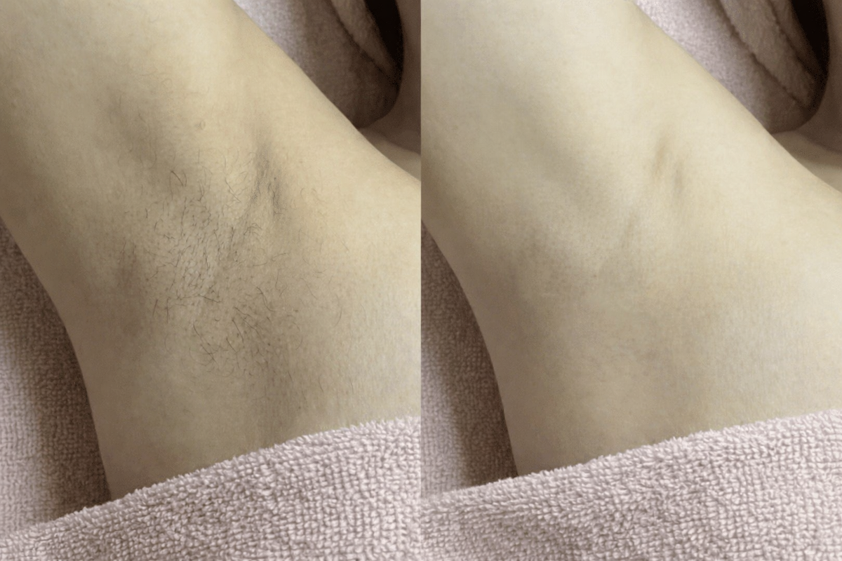 Before and after results - Sofia M.