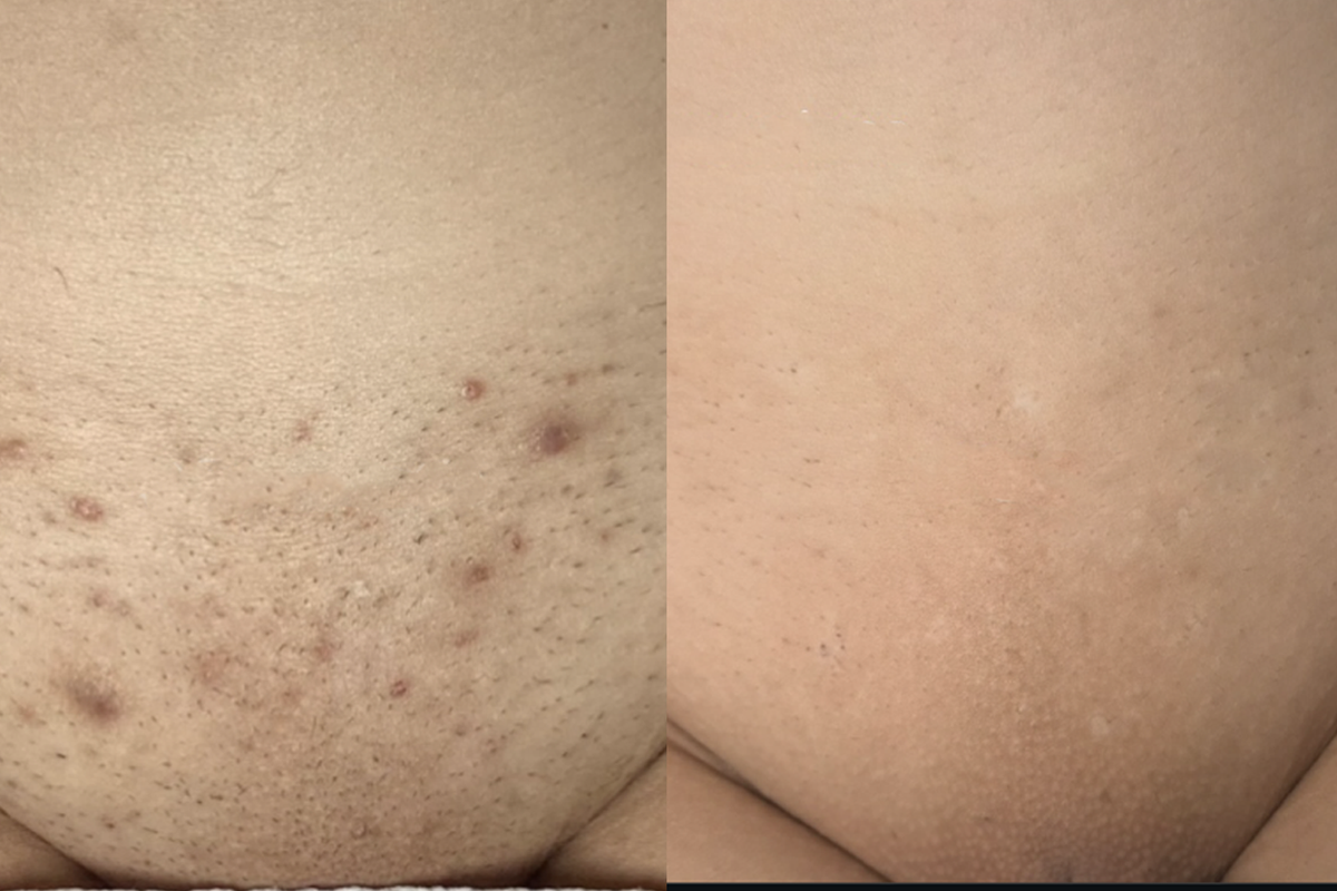 Before and after results - Antonella S.