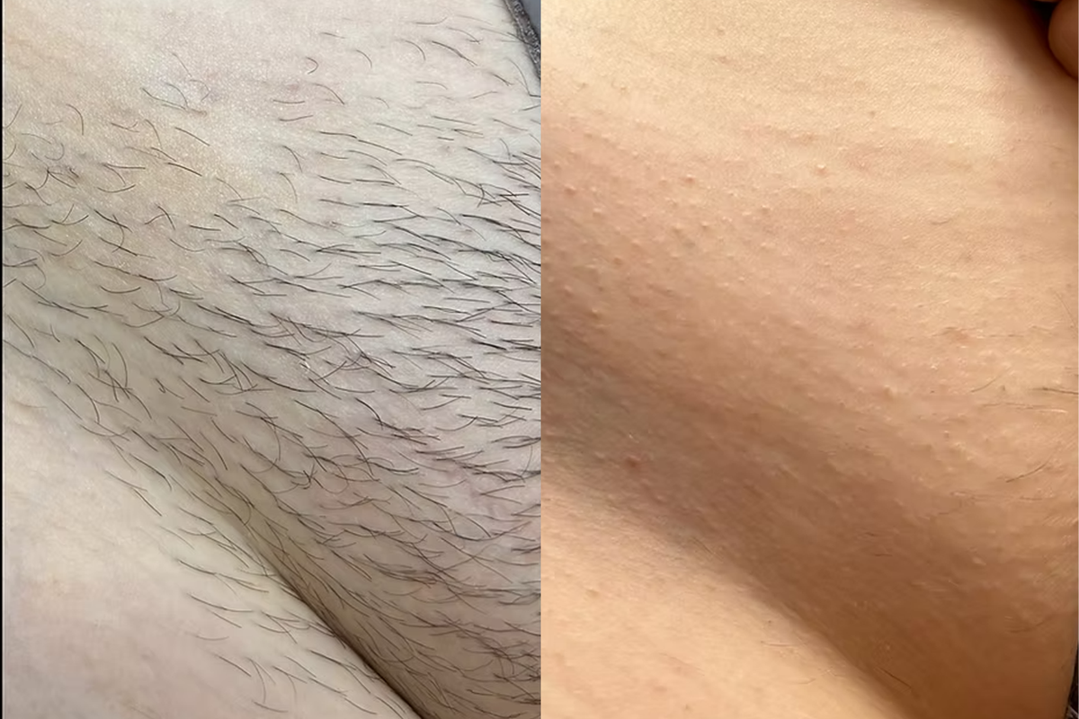 Before and after results - Emma B.